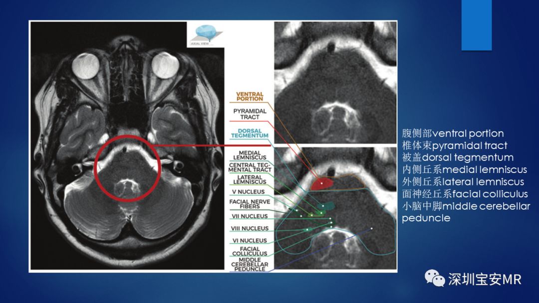 中脑脑桥及延髓解剖和综合征