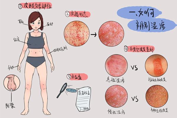 湿疹的主要症状为皮损改变,一般通过皮损分布部位,皮损形态即可分辨.