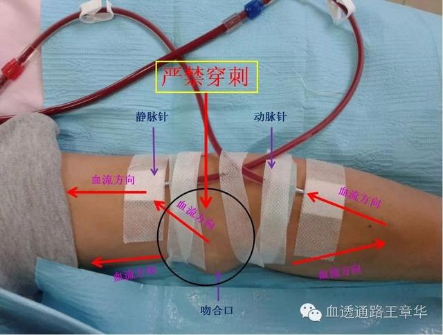 图示:肱动脉-贵要静脉侧侧吻合内瘘血流方向及禁忌穿刺区域示意图21.