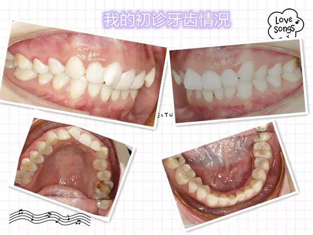 梦见自己把牙齿拔掉了还流血了，探索梦境背后的深层含义