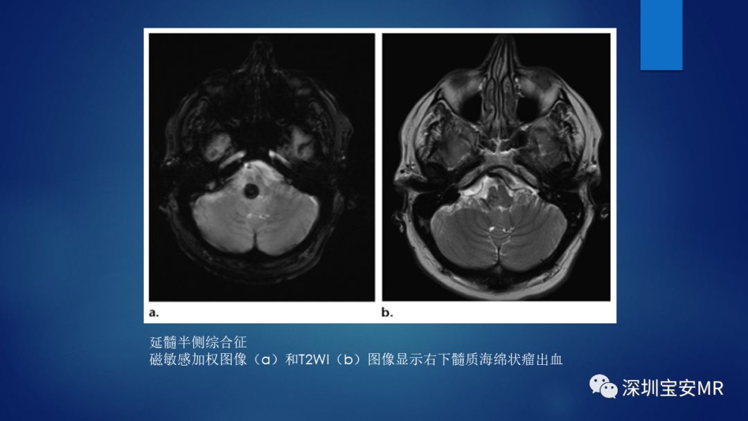 中脑脑桥及延髓解剖和综合征