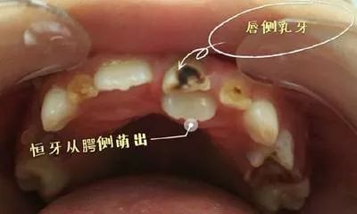 细细研究一下,"双排牙"的坏处还很多,不能放任不管.