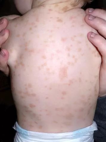 荨麻疹有哪几种图片