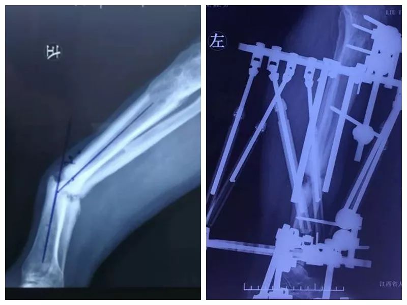 仁医新术丨江西省人民医院开展首例"泰勒六轴外架矫正小腿足踝畸形"