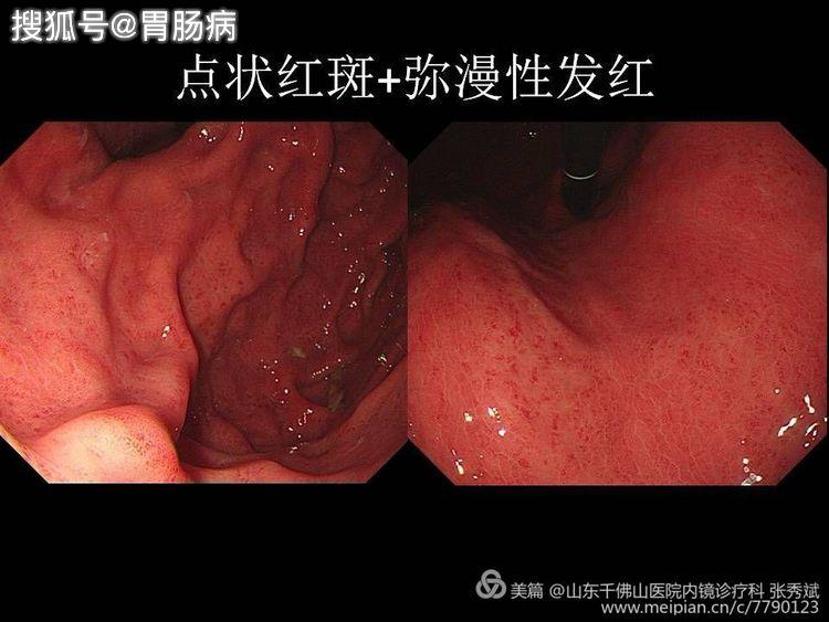 胃炎,胃息肉,幽门螺杆菌感染与胃癌有什么关系?今天讲
