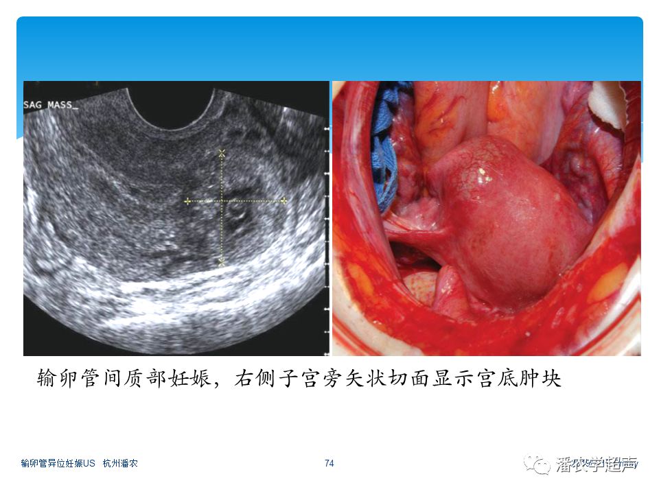 【超声微课堂】输卵管异位妊娠超声诊断思路