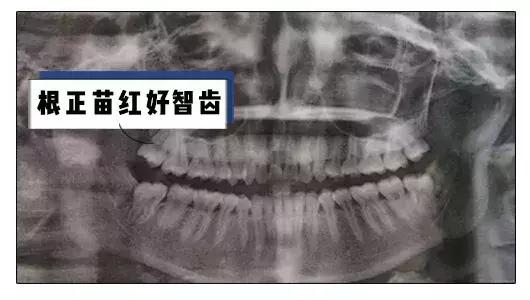 听说拔了智齿可以瘦脸,真的吗?