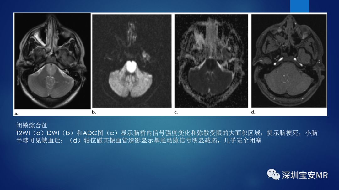 中脑脑桥及延髓解剖和综合征