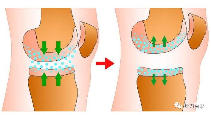 膝关节炎打玻璃酸钠管不管用