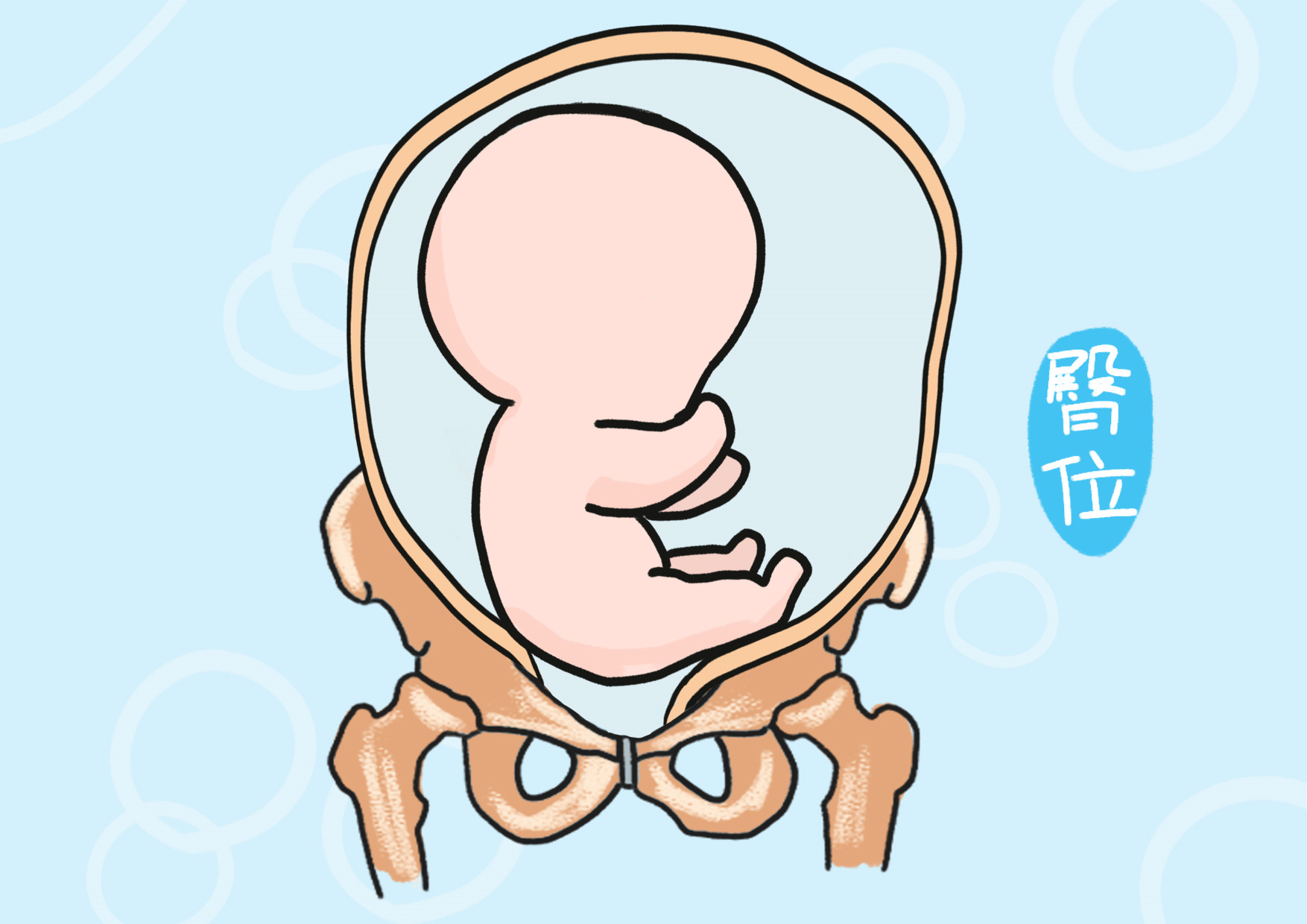 胎儿臀位该如何选择分娩方式？一定要剖腹产吗？_凤凰网健康_凤凰网