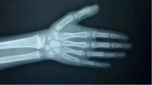 怎么看骨龄图片 0e2552893d96466f8562d9346866bff1.jpeg