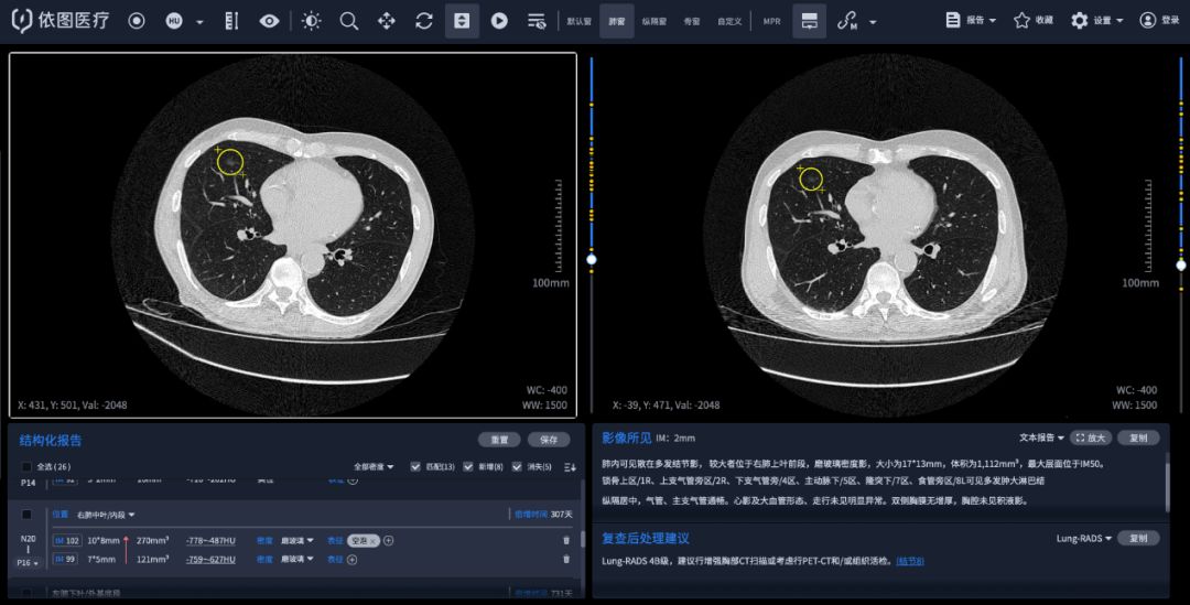 “AI防癌地图” 落地再获突破！1277名志愿者中查出22例疑似肺癌_影像