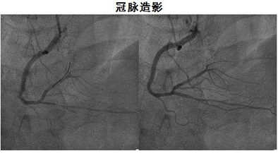 明明有心脏病为啥心脏造影结果正常这么说您就明白了