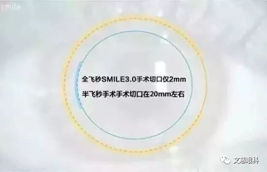 【SMILE全飞秒激光】激光矫正近视靠谱吗?我
