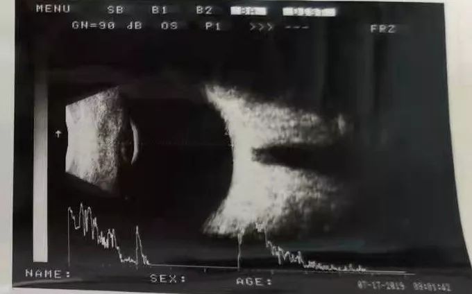 眼部"b超"都知道