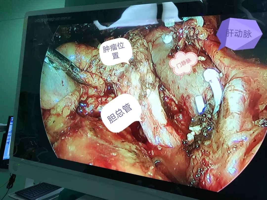 技术技术提高无止境我院肝胆外科完成首例腹腔镜下胆管癌根治暨胆总管