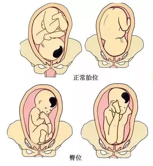 孕38 4周,臀位(臀位是不正常的胎位,就是胎宝宝的体位是屁屁朝下的