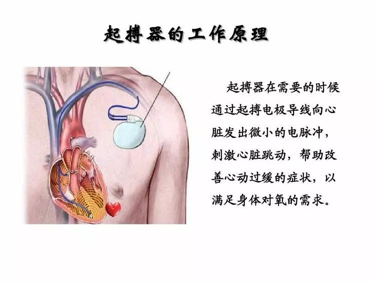 新技术剑川县人民医院开展首例临时心脏起搏术治疗获得成功