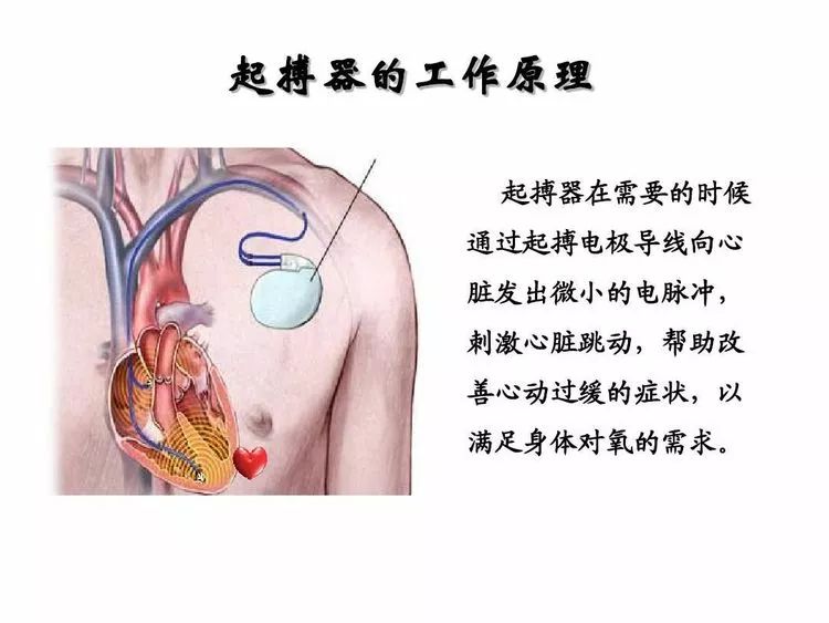 【新技术】剑川县人民医院开展首例"临时心脏起搏术"治疗获得成功