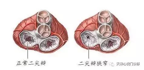 关于心脏二尖瓣异常的中医辨治