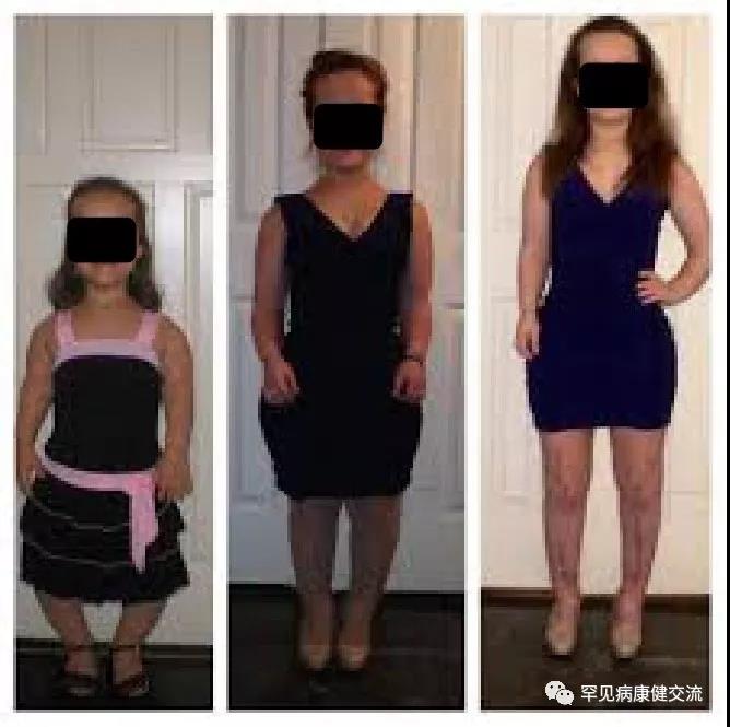 ach|软骨发育不全肢体矫形延长策略的科普