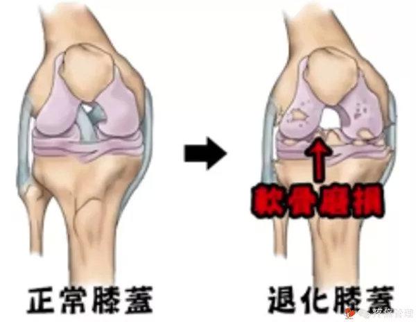 这五个生活常见因素害你膝盖退化更快_膝关节