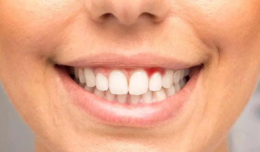 什么原因会引起牙床肿痛 be3073e4f2d44faea4b9c63f7d2893d8.jpeg