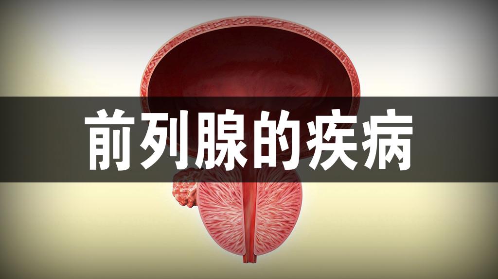 潘医生:前列腺炎如何分类