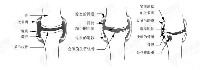 胸口软骨受伤怎么办