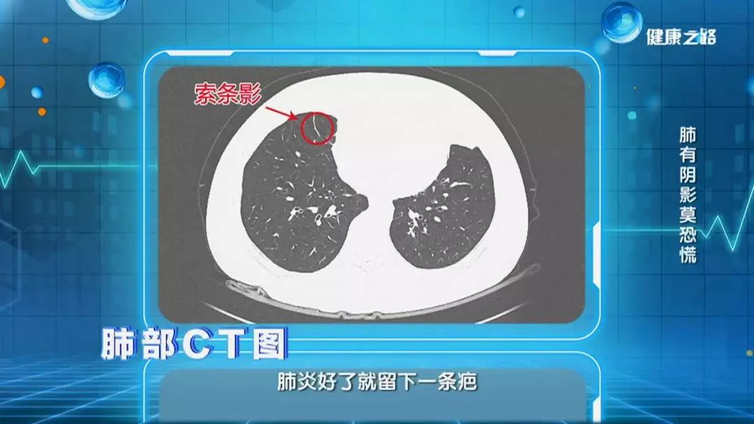 体检后发现肺部有"阴影 "!一定是得了肺癌?来,给