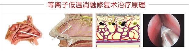 鼻甲肥大怎么办