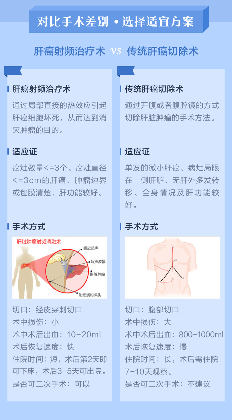 治疗肝癌的微创利器射频消融rfa