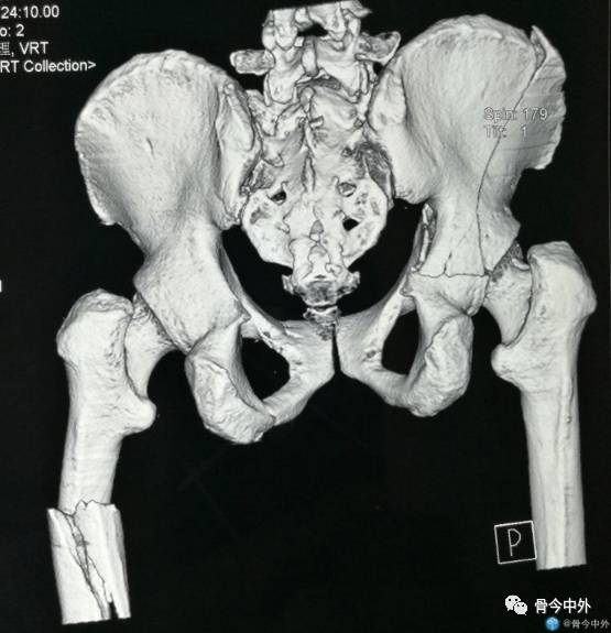 髋臼骨折的分型,诊断及治疗!