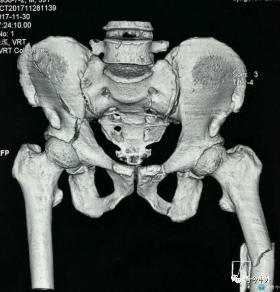 髋臼骨折的分型诊断及治疗