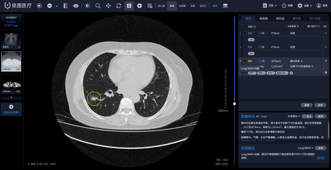 “AI防癌地图” 落地再获突破！1277名志愿者中查出22例疑似肺癌_影像