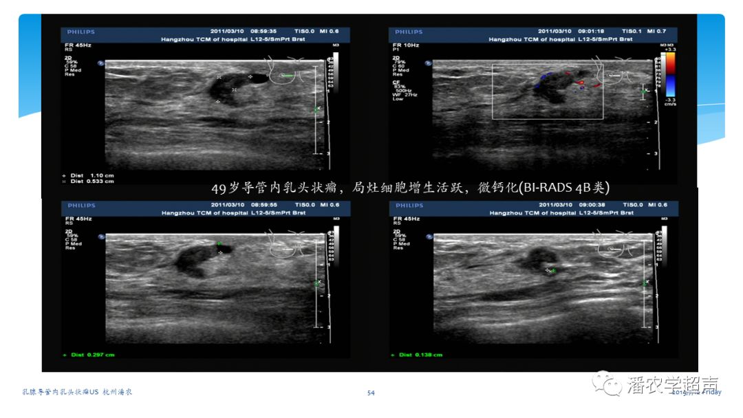 【超声微课堂】乳腺导管内乳头状瘤超声诊断