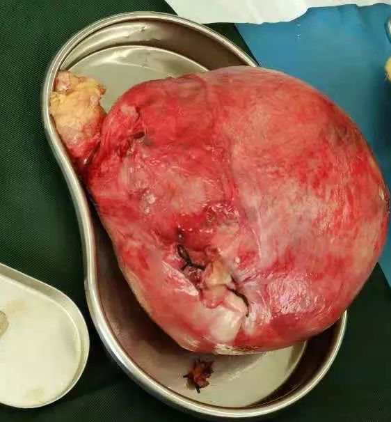 医者仁心,妙手回春 ||武威丽人成功实施一例巨大子宫肌瘤切除术!