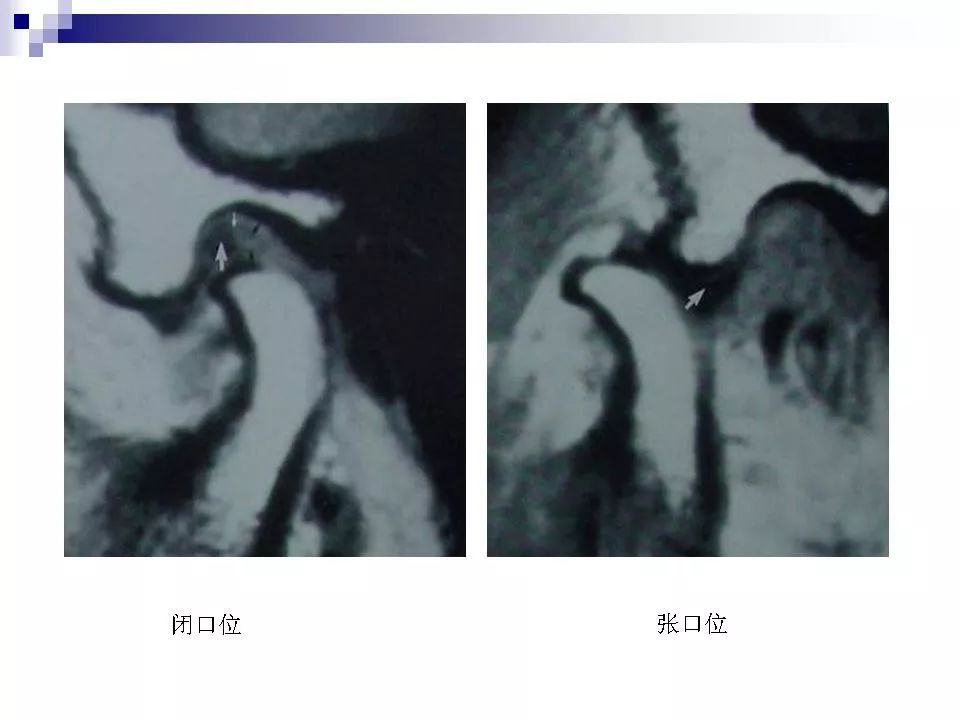 颞下颌关节的磁共振成像影像天地