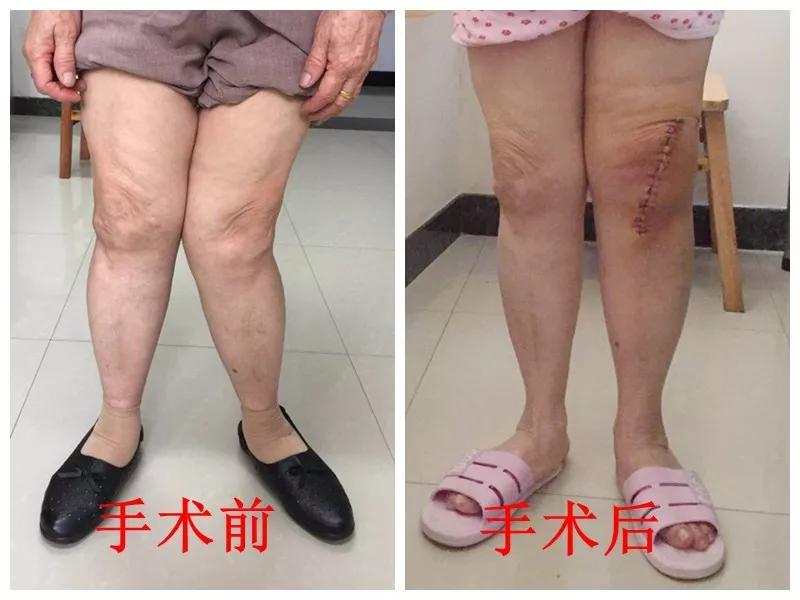 膝关节置换医院排名_膝关节置换图片(2)