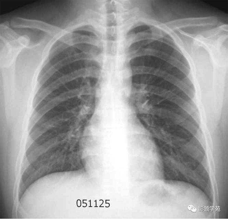 有些病例具有支气管肺炎,即小叶性肺炎的特点.