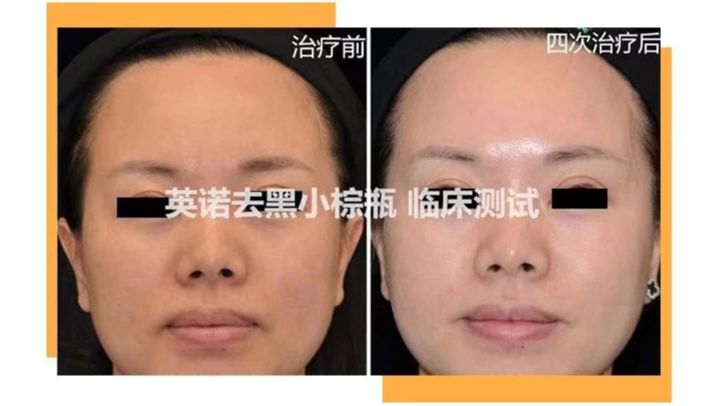 用什么可以美白褪黑色素 56942efd1c9648c4a7b84abfc6c3e55e.jpeg