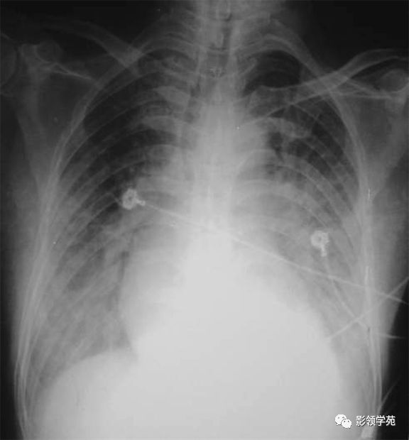 表现为呈中心分布的蝶翼状实变阴影四,x线胸片的诊断价值人禽流感肺炎