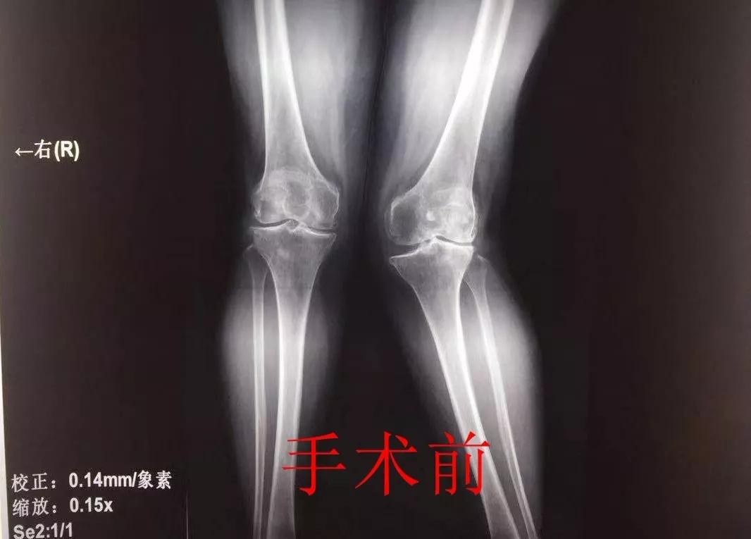 膝关节置换医院排名_膝关节置换图片(2)