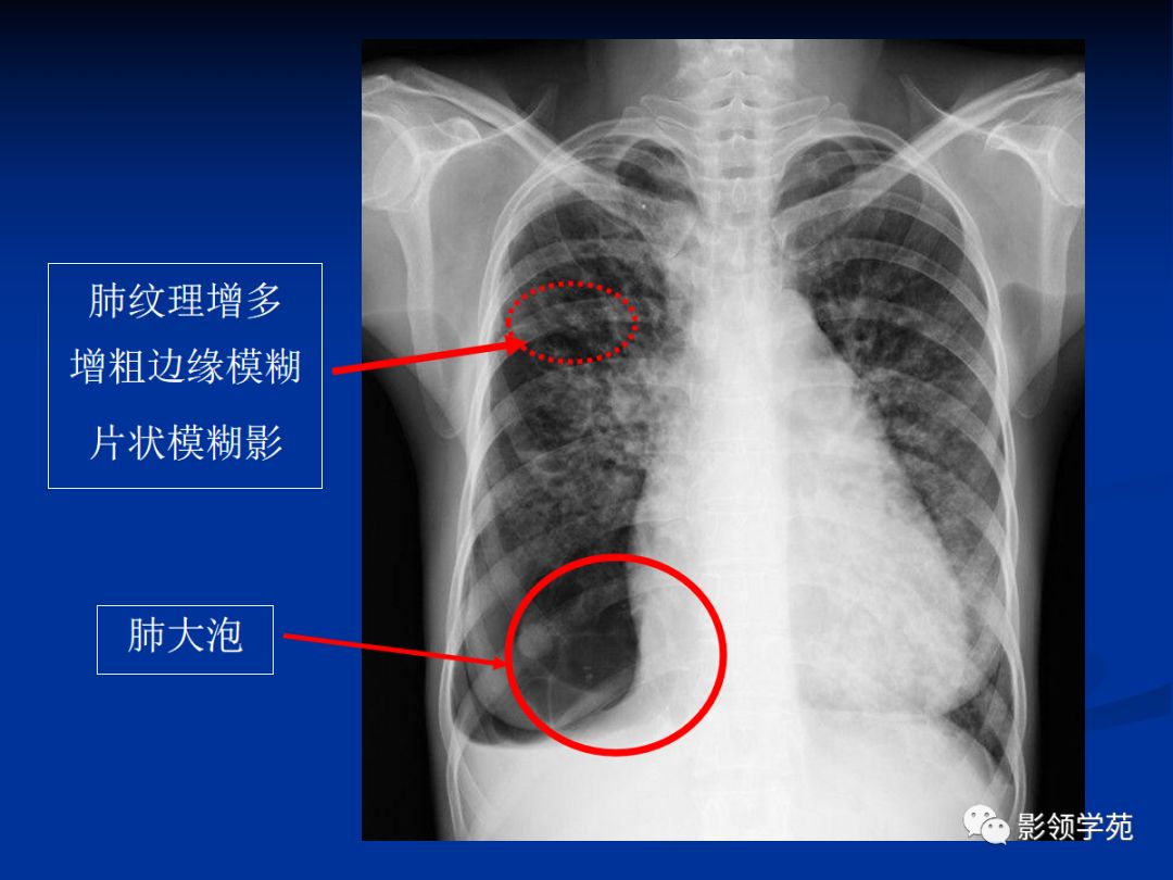 ct表现:①心影增大;②肺淤血;③肺水肿以间质性肺水肿为著;④胸腔积液