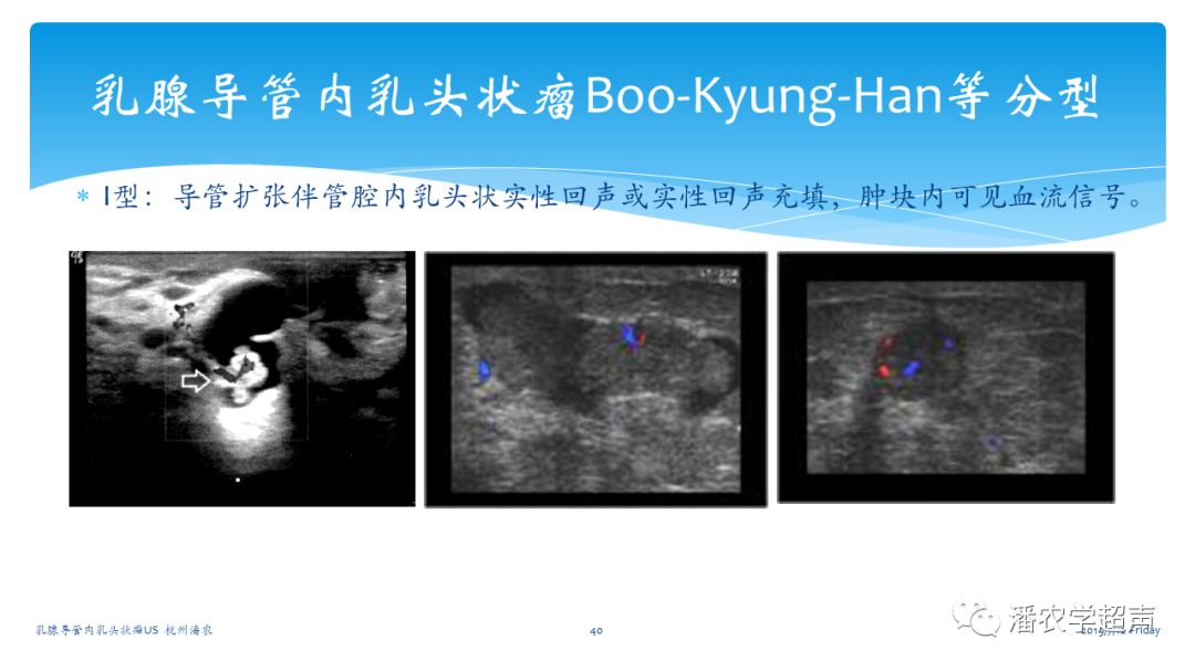 【超声微课堂】乳腺导管内乳头状瘤超声诊断