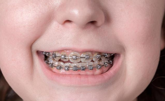 这款专门为儿童打造的隐形牙套解决了很多问题它叫frist