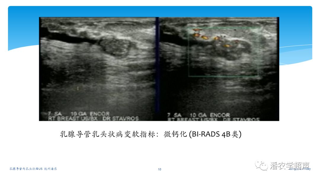 超声微课堂乳腺导管内乳头状瘤超声诊断