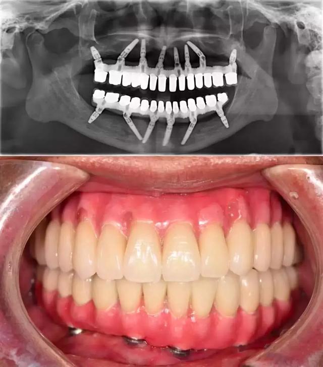 90% 中国人的牙齿,正在被这种疾病杀死,而他们对此毫不知情