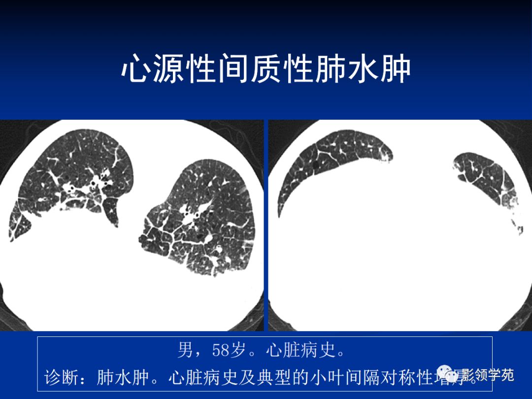 不同类型肺水肿的ct表现