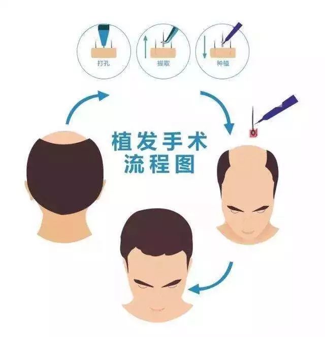 误区四:植发可以一劳永逸